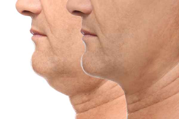 HIFU - Breakthrough in Anti - ageing 2 hifu results Leigh-on-Sea