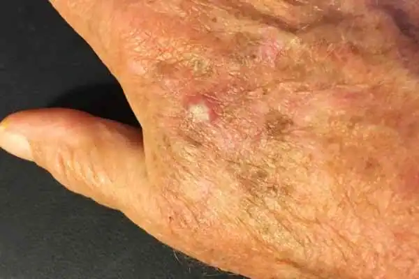 Cryopen For Actinic Keratoses 1 Image of Actinic keratoses Leigh-on-Sea on a person hand